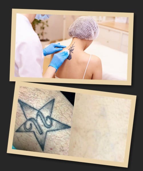 вартість лазерного видалення тату