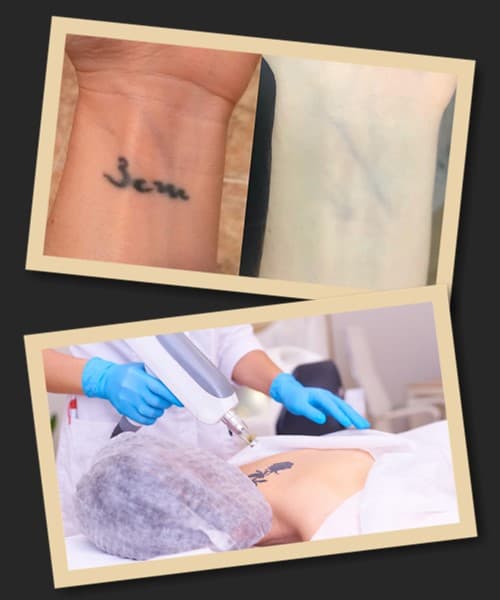 видалення татуювань