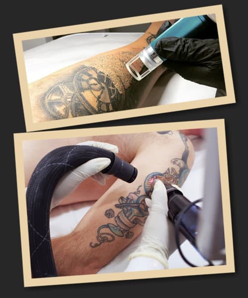 Вивести татуювання Київ