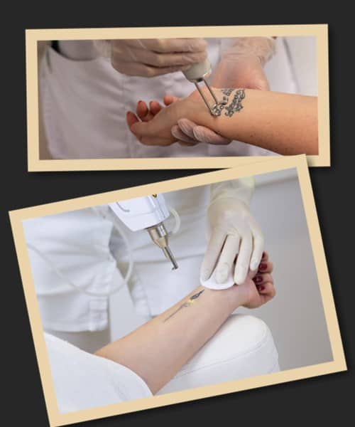 Неодимовий лазер видалення тату