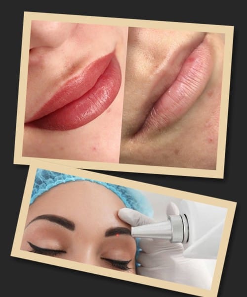 виправлення неякісного татуажу за допомогою лазера