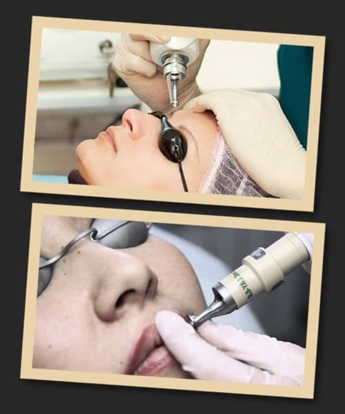 виправити татуаж лазером