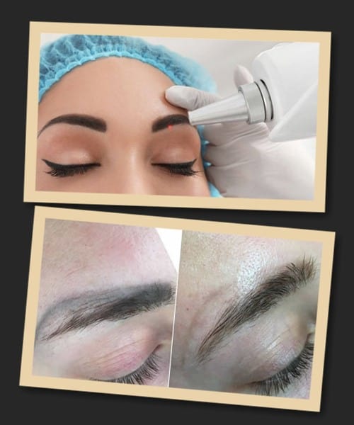 Видалення татуажу брів