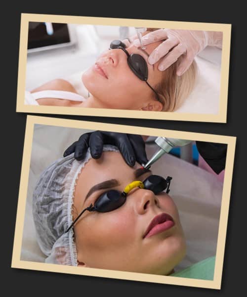 Лазерне видалення татуажу брів