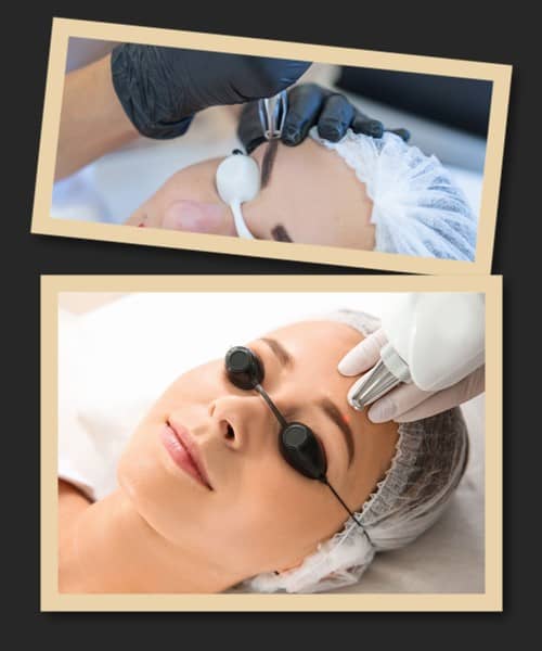 виводити перманентний макіяж брів лазером