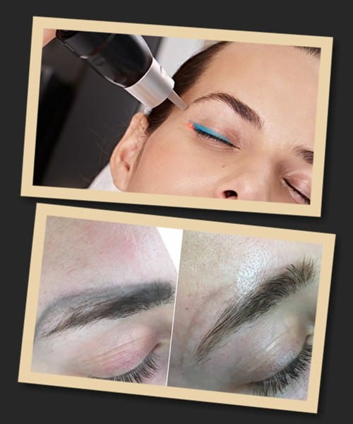 Лазерний метод дозволяє вивести татуаж