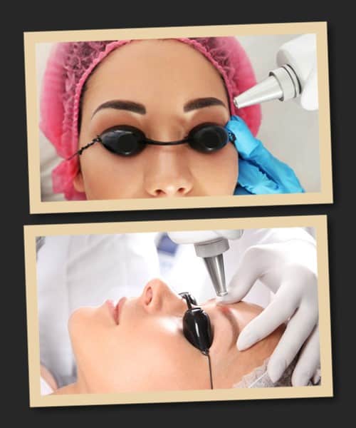 Видалення татуажу брів за допомогою лазера