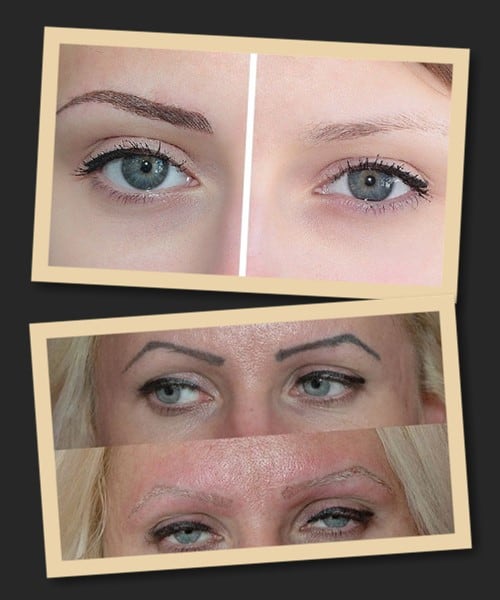 Методи видалення татуажу брів