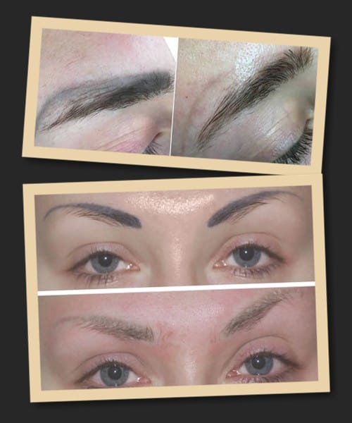 Лазерне видалення татуажу брів