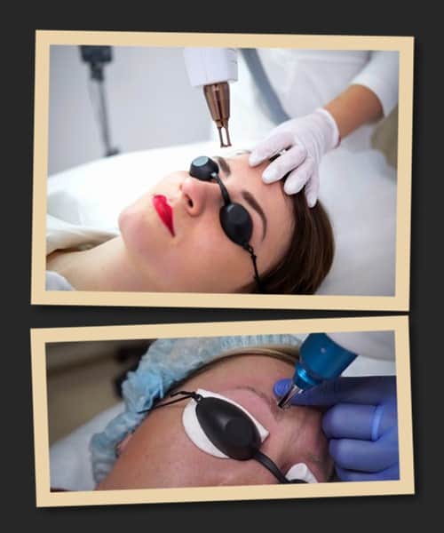 Лазерна методика видалення татуажу