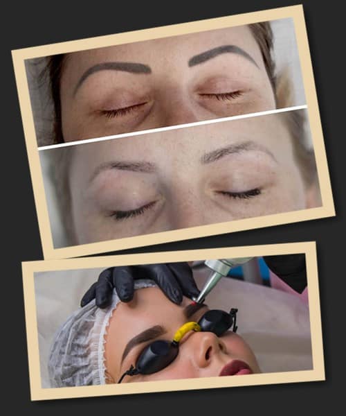 Причини видалення татуажу брів