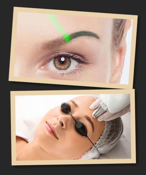 Особливості лазерної процедури при виведенні пігментів татуажу