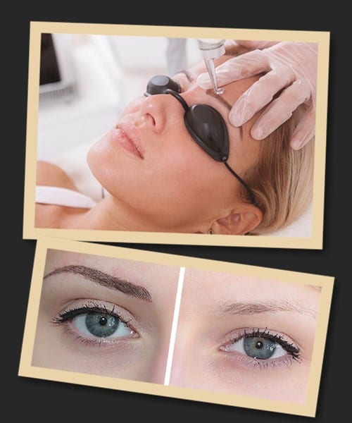 Видалити татуаж брів