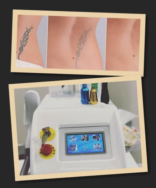 Особливості видалення тату гелевою ручкою