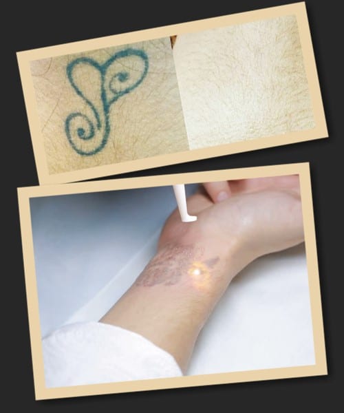 Очищення тату лазером