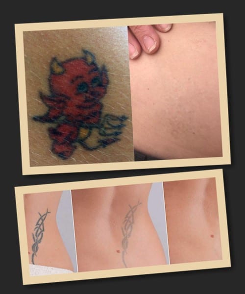 виправити татуювання