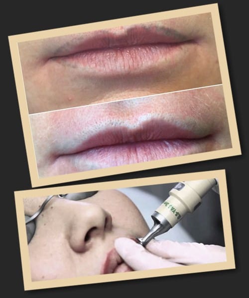 як виправити татуаж губ в Києві