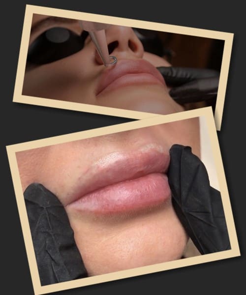 Як виправити татуаж губ ефективно та безпечно