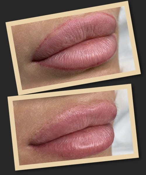 Видалити татуаж губ лазером