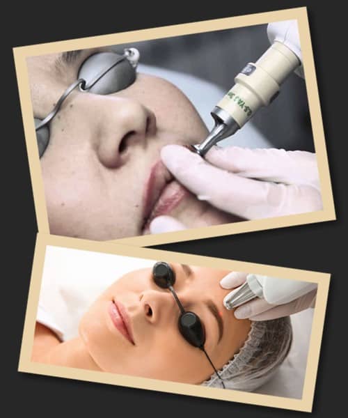 кров після лазерного видалення татуажу