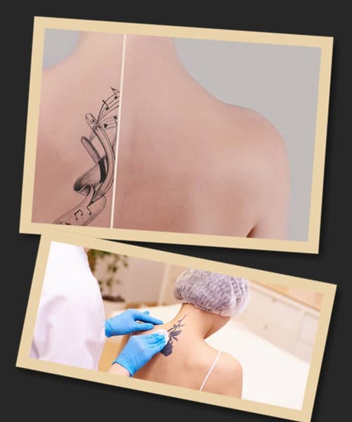 Лазерне видалення татуювань: до та після