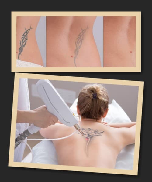 Які існують способи видалення тату