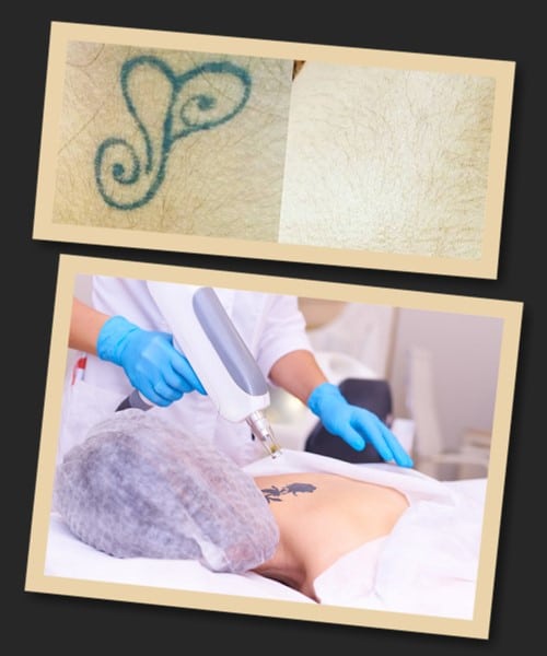 Переваги виведення татуювань лазером