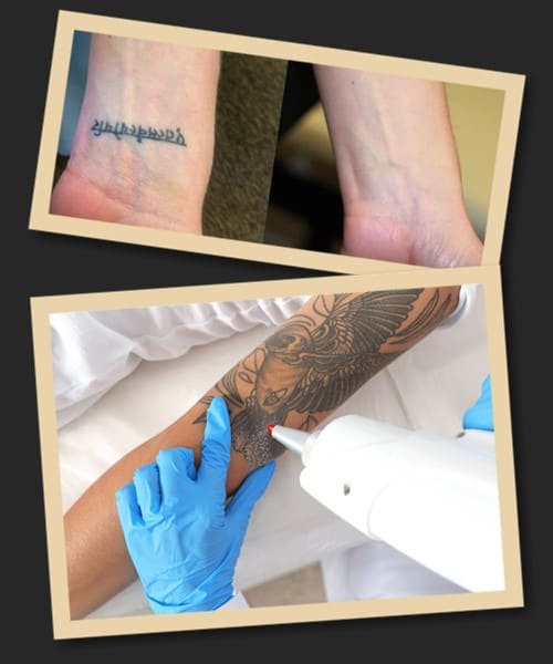 Переваги лазерного видалення тату