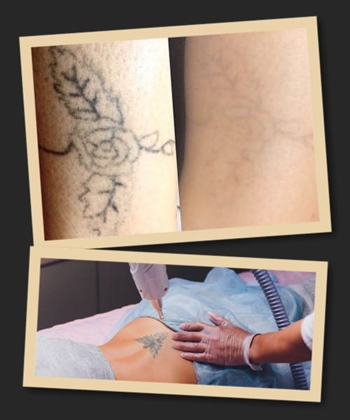 ефективність лазерного виведення татуювання