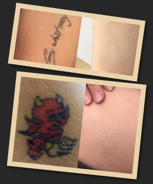 виведення татуювання