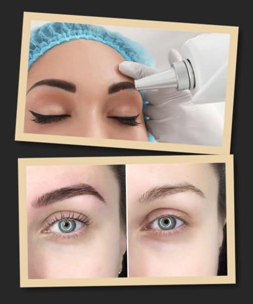лазерне видалення татуажу брів до та після