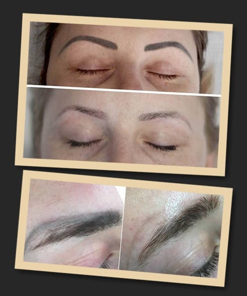 видалення татуажу брів до та після