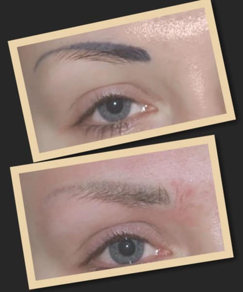 Лазерне зведення перманентного макіяжу