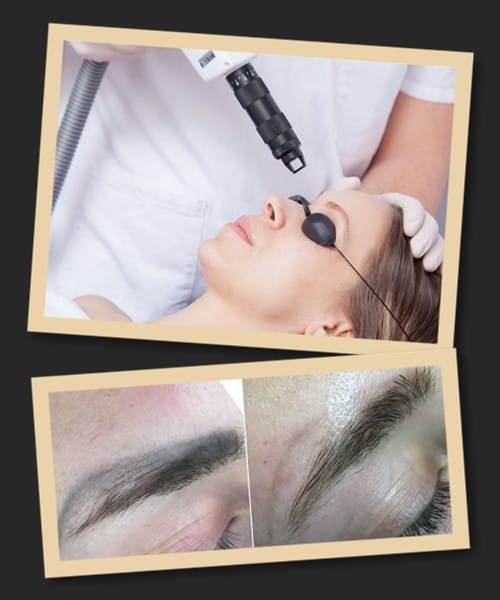 Протипоказання до лазерного видалення перманентного макіяжу