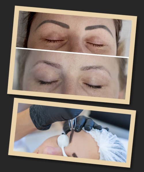 способи видалення татуажу