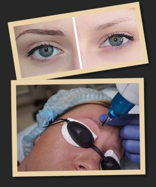 Переваги застосування лазера для виведення татуажу