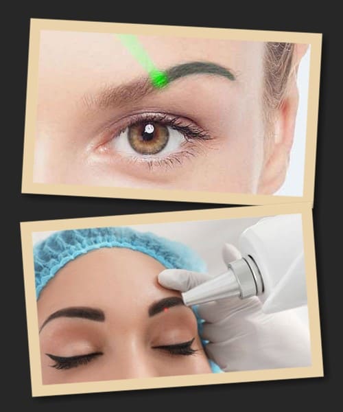 ефективність лазерного видалення татуажу