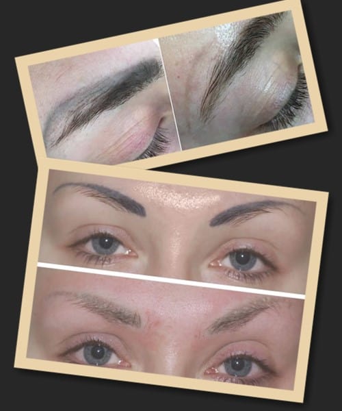 лазерне видалення татуажу