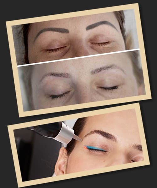 Перекриття і видалення старого татуажу