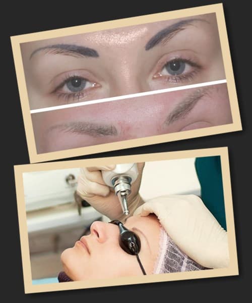 Після лазерного видалення татуажу брів