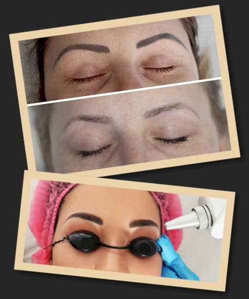 Способи видалення татуажу