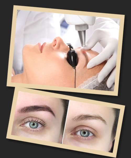 Видалення татуажу лазером