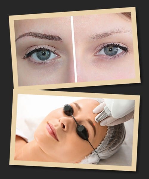 Виведення татуажу лазерним апаратом