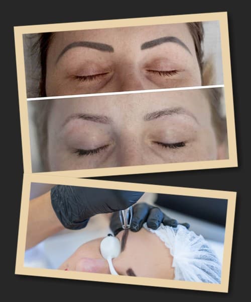 Лазерне зведення перманентного макіяжу