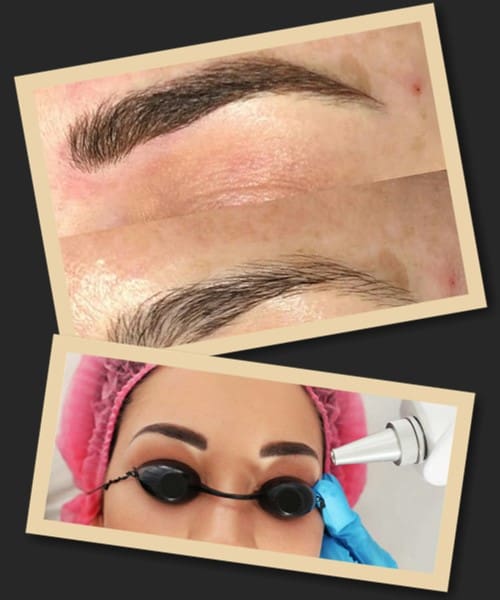 зводити татуаж лазером