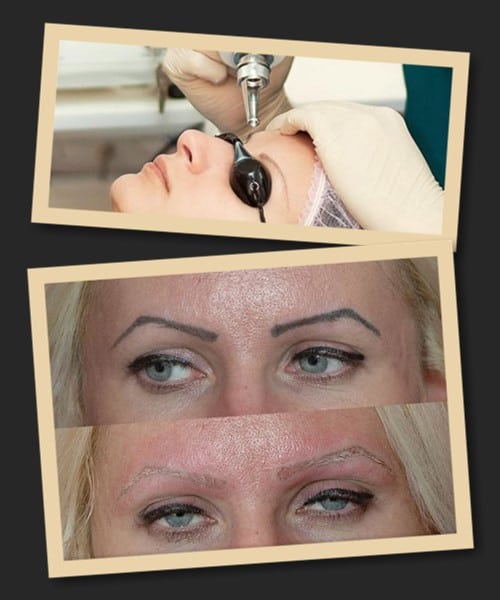 зведення перманентного макіяжу лазерним пристроєм