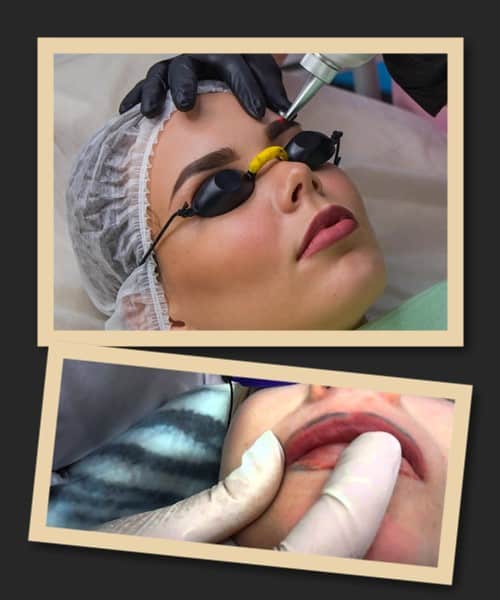 Способи зведення татуажу