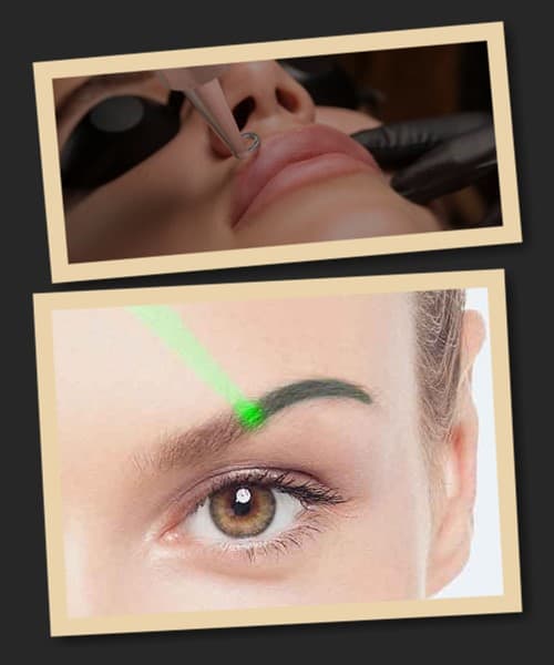 Переваги лазерного методу зведення татуажу