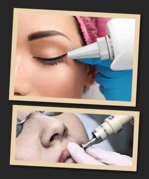 Процедура лазерного зведення перманентного макіяжу