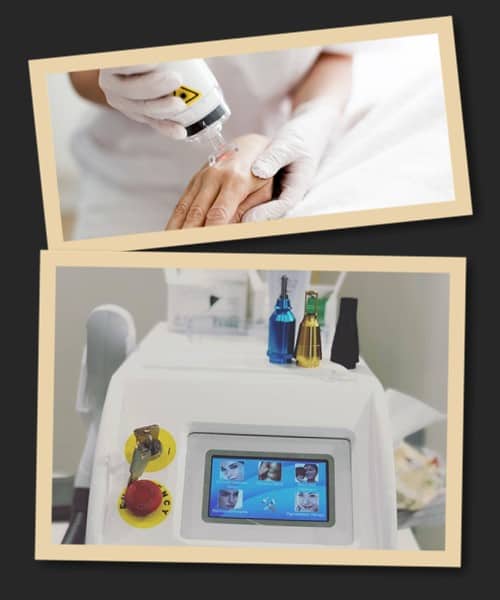 Поради для тих хто вирішив вивести татуювання лазером